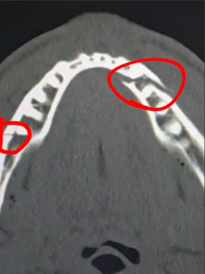 Jake Paul sufrió una doble fractura de mandíbula durante su pelea ante Anthony Joshua (Instagram/@jakepaul)