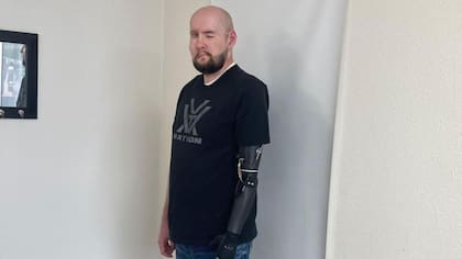 James perdió el brazo y la mayor parte de la cara en el accidente de alta tensión