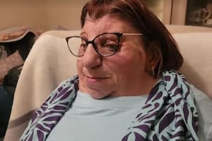 Janet Craven nació con un raro trastorno genético llamado síndrome de Treacher Collins