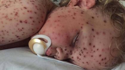 Jasper Allen tuvo varicela, pero aparecieron perfiles falsos recaudando dinero y diciendo que tenía cáncer