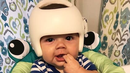 Jonas Gutierrez nació con el síndrome de la cabeza plana y tiene que usar un casco para corregir la deformidad