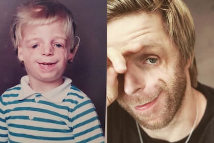 Jono Lancaster tiene Treacher Collins, una patología que impide el desarrollo del cráneo, las mejillas y la mandíbula