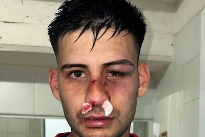 Juan Pacchini, de Brown de Adrogué, sufrió una brutal patada en la cara durante el partido contra Atlético Rafaela, tiene una fractura nasal y varios hematomas