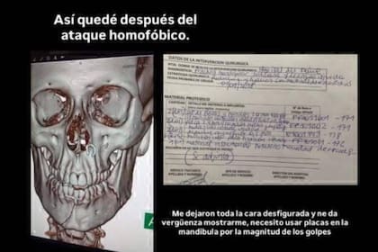 Juan Sabín posteó en sus redes el informe médico tras el ataque de odio que recibió; debieron reconstruirle la mandíbula con placas