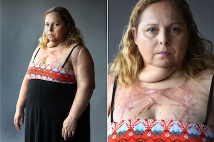 Karina Abregú sufrió un intento de femicidio: Gustavo Javier Albornoz la roció con alcohol y la prendió fuego. Fotos: Fernando Gutierrez