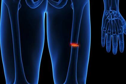 Debido a su condición, Kat sufre fracturas frecuentes.
