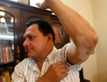 Kevin Roca Alpire, tras el accidente aéreo que protagonizó a fines de 2013 en Bolivia