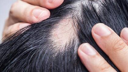 La alopecia puede afectar el cuero cabelludo, cara y otras partes del cuerpo como las axilas