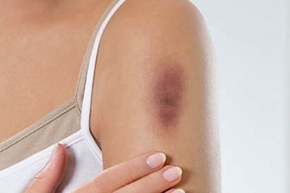 La aparición de hematomas de manera repentina están vinculadas comúnmente al envejecimiento. Sin Embargo, estas pueden ser debido a a la deficiencia de vitaminas como la C y la K1