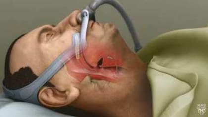 La apnea del sueño suele tratarse con el uso de una máquina CPAP