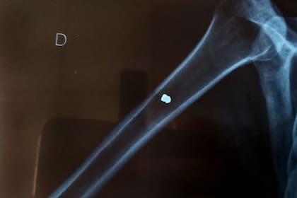 La bala quedó alojada en el hueso y el hombre deberá ser operado