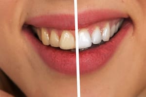 La bebida orgánica que es ideal para eliminar el sarro de tu boca