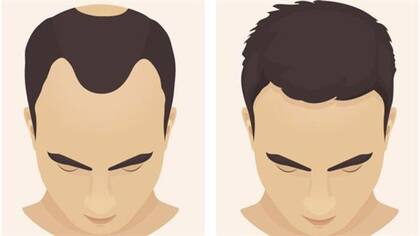 La caida del cabello afecta más a hombres que a mujeres.