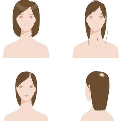 La caida del cabello puede ser por zonas pequeñas.