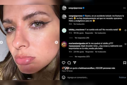 La China Suárez compartió en redes sociales las consecuencias del accidente que sufrió (Foto Instagram @sangrejaponesa)