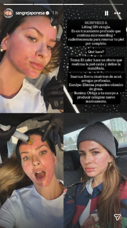 La China Suárez se hizo un lifting en Turquía y mostró cómo le quedó la cara (Foto: Instagram @sangrejaponesa)