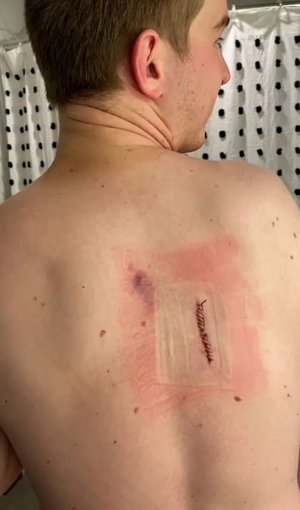 La cicatriz del TikToker tras extirparle los dos lunares malignos
Fuente: SWNS