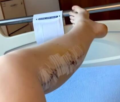 La cicatriz que quedó en su pantorrilla