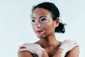 La enfermedad de la piel que a pesar de ser común es muy poco conocida