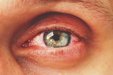 Remedios caseros para aliviar los ojos rojos: por qué se ponen así y cómo tratarlo