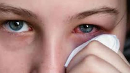 La conjuntivitis es la inflamación de la conjuntiva (envolturas externas del ojo)