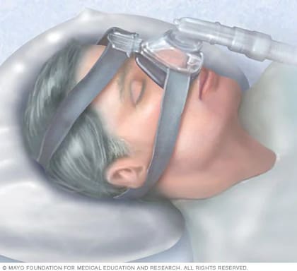 La CPAP es una máquina para tratar la apnea (Foto: Mayo Clinic)