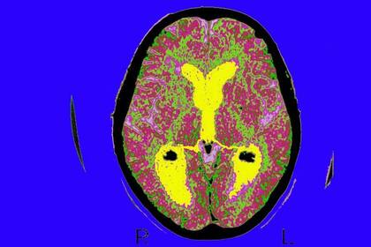 La cura de la demencia es una de nuestras asignaturas pendientes. En la imagen, el cerebro de una persona con alzhéimer