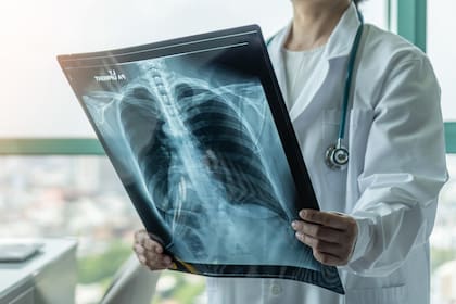 La detección a tiempo del cáncer de pulmón es crucial para su cura