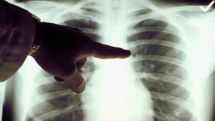 La detección a tiempo del cáncer es muy importante