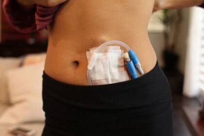 La diálisis peritoneal permite a pacientes como Pérez sustituir la función de los riñones, pero no es una solución permanente.