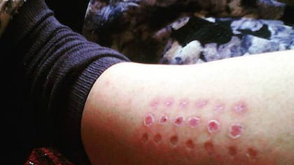 La dosis— el número de puntos— y la periodicidad de la aplicación depende de la edad y la constitución de la persona