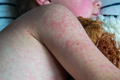 La Dra. Lysette indicó que el sarampión también es una enfermedad viral altamente contagiosa, la cual se transmite por el aire cuando la persona infectada tose o estornuda (Foto Pexels)