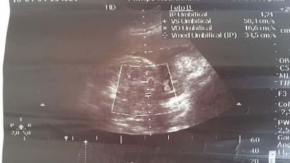 La ecografía donde figuran los dos fetos