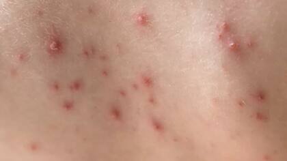 La enfermedad es transmisible mientras existan vesículas o ampollas intactas; cuando la última lesión se seca y se transforma en costra deja de ser contagiosa