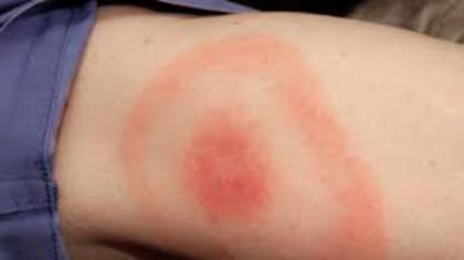 La erupción en la piel es muy notoria tras la picadura