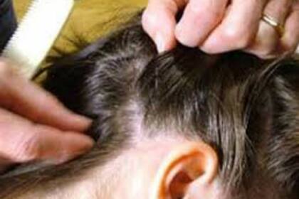 La escuela y las colonias de vacaciones son los lugares más comunes para contagiarse de piojos