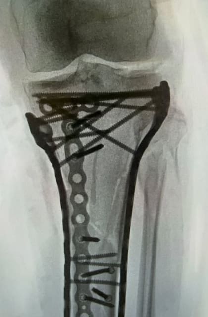 La estructura metálica que sostiene la pierna de Lindsey Vonn