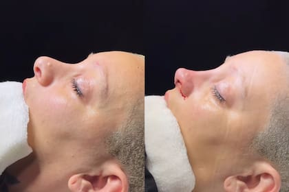 La exhermanita compartió todo el proceso de su operación en sus redes sociales (Captura: Instagram @furiascaglione)