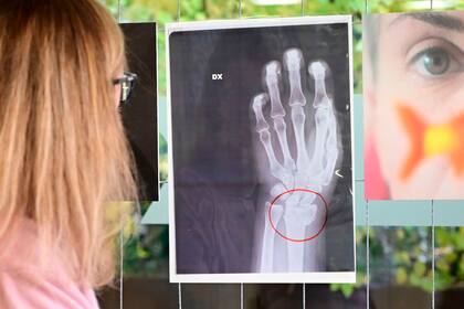 La exposición "La invisibilidad no es un superpoder" incluye radiografías de mujeres anónimas que llegaron al servicio de emergencia del hospital, después de ser víctimas de violencia