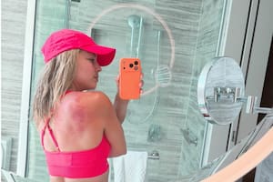 La foto de la mexicana Renata Zarazúa con la espalda quemada