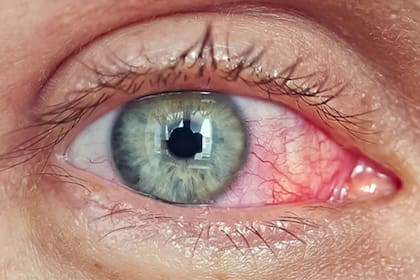 La fotoqueratitis surge por la exposición intensa o prolongada a la luz UV y se presenta con dolor, enrojecimiento y sensibilidad