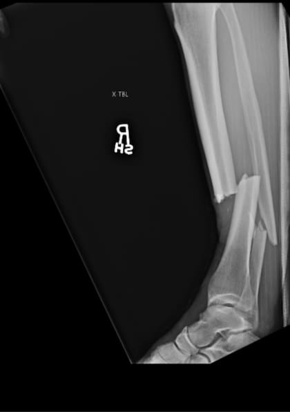 La fractura de Weidman tras la patada en pleno combate