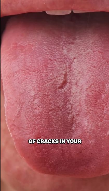 La grieta en la lengua es uno de los primeros indicios, según el médico, que podría advertirte sobre tu consumo de café