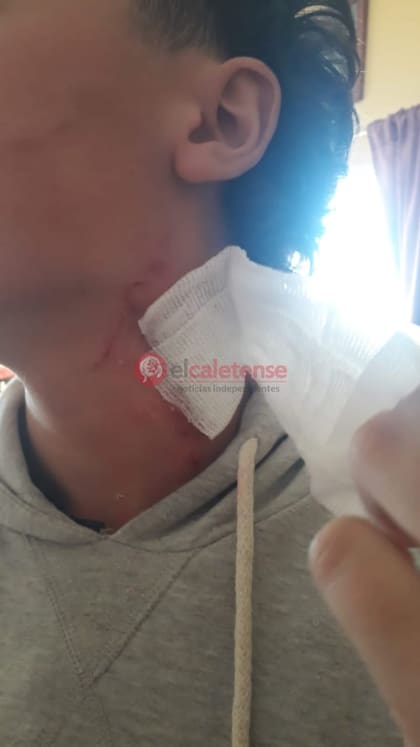 La herida del adolescente tras ser mordido por el pitbull
Foto: El Caletense