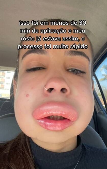 La historia de Isis, una joven brasileña que tuvo una reacción alérgica a causa de una cirugía 
Foto: TIKTOK / @isispolivx