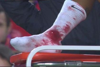 La imagen del tobillo ensangrentado de Neymar