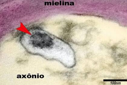 La imagen muestra un axón de una neurona en el cerebro de un niño con síndrome inflamatorio multisistémico pediátrico (SIM-P). La flecha señala al virus SARS-CoV-2 en una vesícula en el citoplasma del axón.