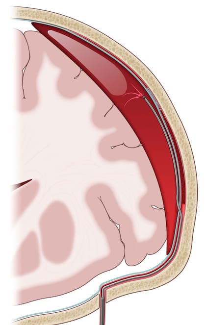 La imagen muestra un pequeño catheter navegando dentro de la cabeza dentro de una arteria, después saliendo de la misma y drenando sangre de la superficie del cerebro (hematoma subdural)