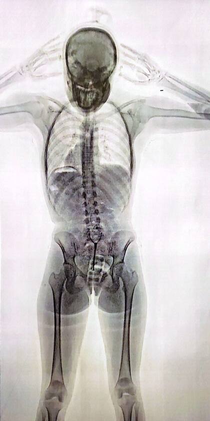 La imagen que mostró el Body Scam del cuerpo de A. S. F., la "mula" que intentó volar a España con 78 cápsulas de cocaína en su cuerpo