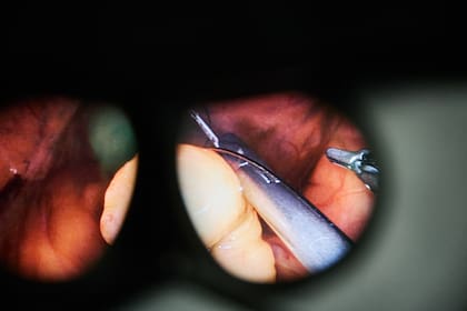 La imagen que recibe el cirujano está ampliada 16 veces y en 3D, una combinación que mejora la precisión en un espacio anatómico muy reducido